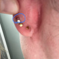 Understanding the Differences Between Keloid Bumps and Hypertrophic Scars