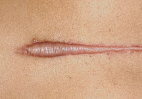 Understanding Keloid Scars: How to Identify and Treat Them